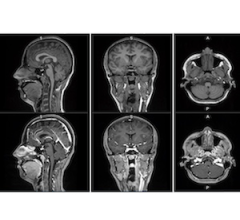 Fujifilm Launches APERTO Lucent 0.4T Open MRI System | Imaging